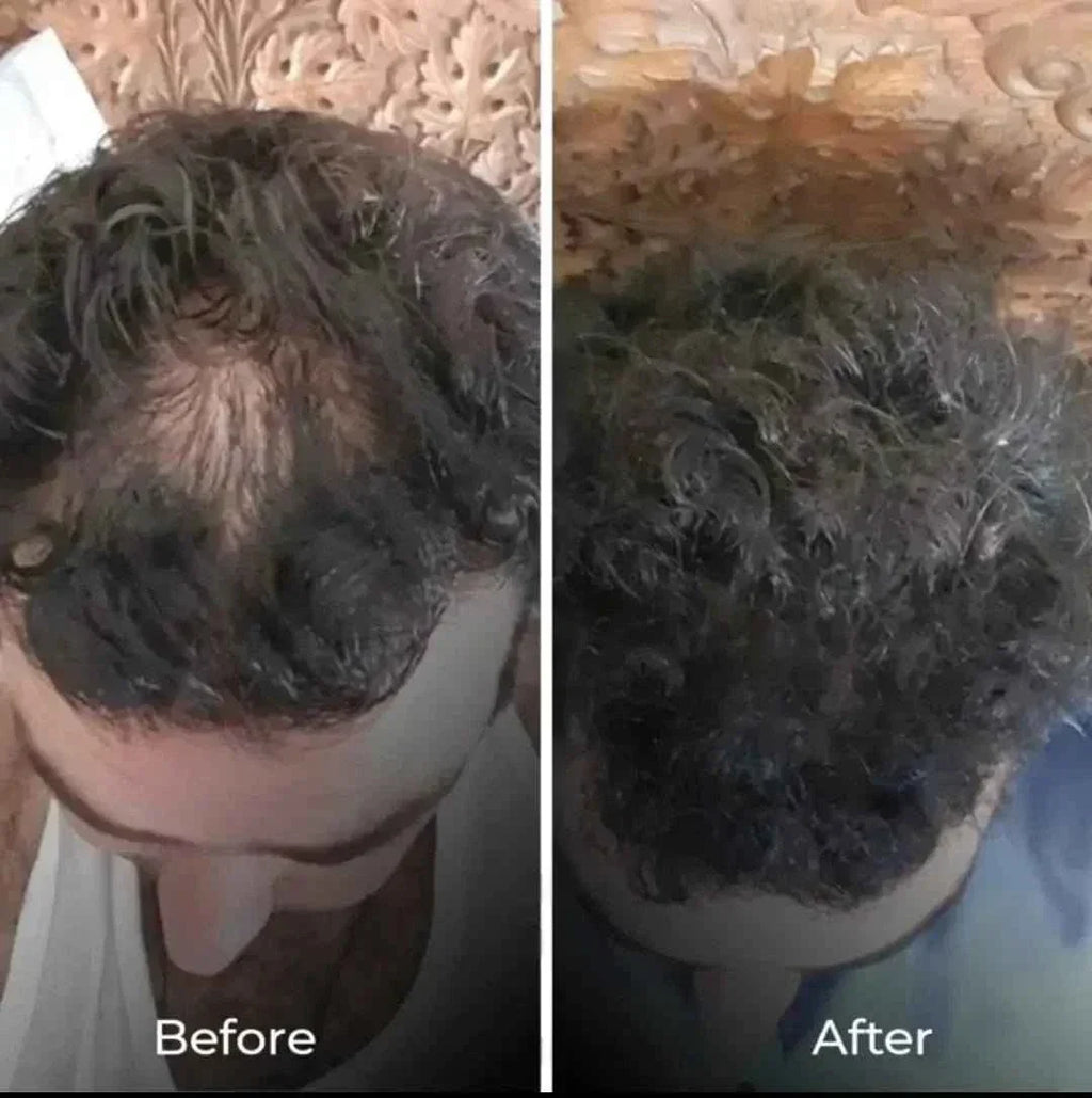 Derma roller | best Derma roller for hair and beard growth