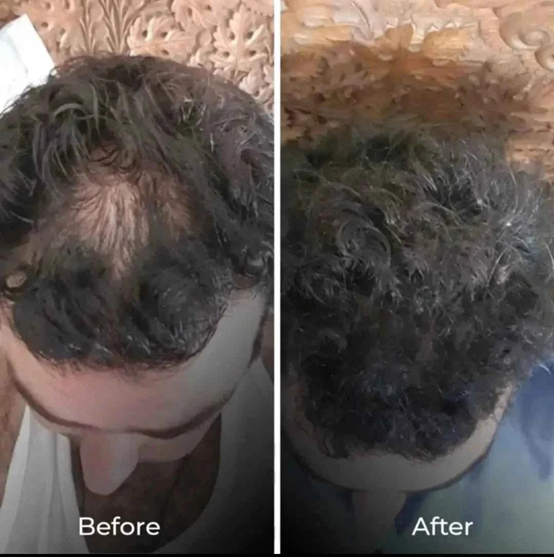 Derma roller | best Derma roller for hair and beard growth