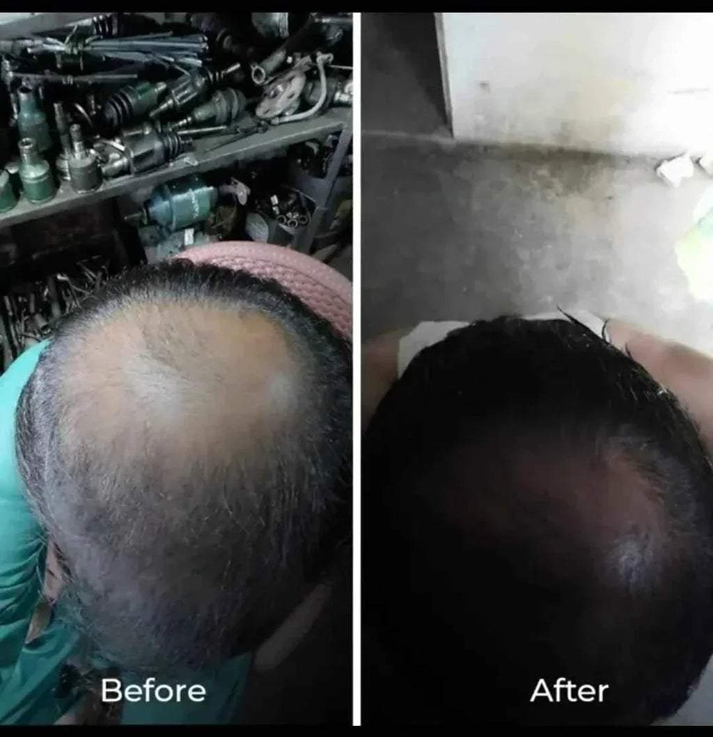 Derma roller | best Derma roller for hair and beard growth