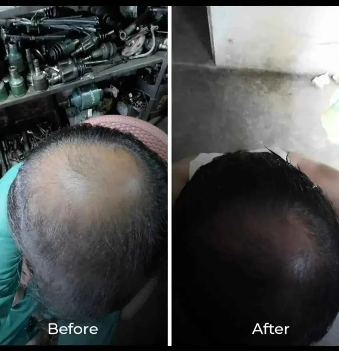Hair growth oil with derma roller for hair and beard growth