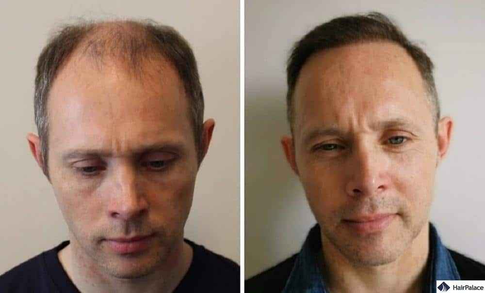 Hair growth oil with derma roller for hair and beard growth | BZOZ |