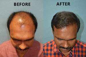 Herbal Hair Growth Shampoo | Herbal Growth Oil | Derma Roller