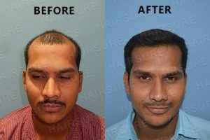 Herbal Hair Growth Shampoo | Herbal Growth Oil | Derma Roller